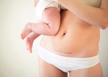 Április, a császármetszés hónapja – beszéljünk róla